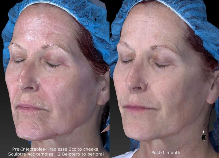 Before and after oblique image of Radiesse, Belotero and Sculptra treatment on a female's cheeks performed by Dr. Fabi at our San Diego medical spa