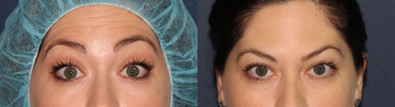 Before and after front image of Botox treatment on a female's forehead lines performed by Dr. Fabi at our San Diego medical clinic
