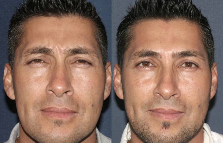 Before and after front image of Botox treatment on a male's glabellar lines performed by Dr. Fabi at our San Diego medical spa