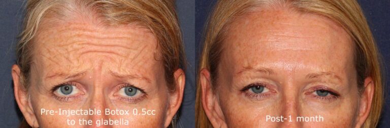 Before and after front image of Botox treatment on a female's forehead lines performed by Dr. Fabi at our San Diego medical clinic