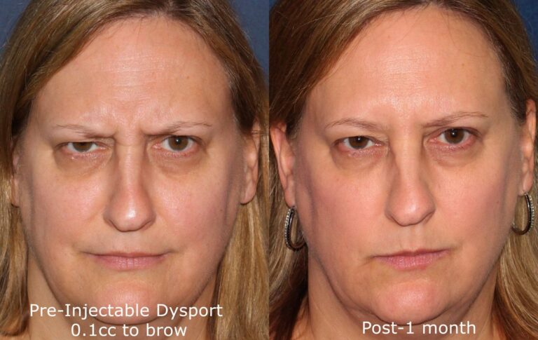 Before and after front image of Dysport treatment on a female's glabellar lines performed by Dr. Fabi at our San Diego medical spa