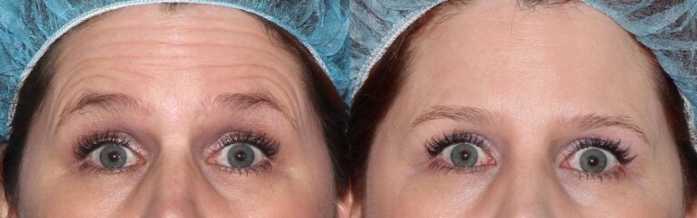 Before and after front image of Botox treatment on a female's forehead lines performed by Dr. Fabi at our San Diego medical spa