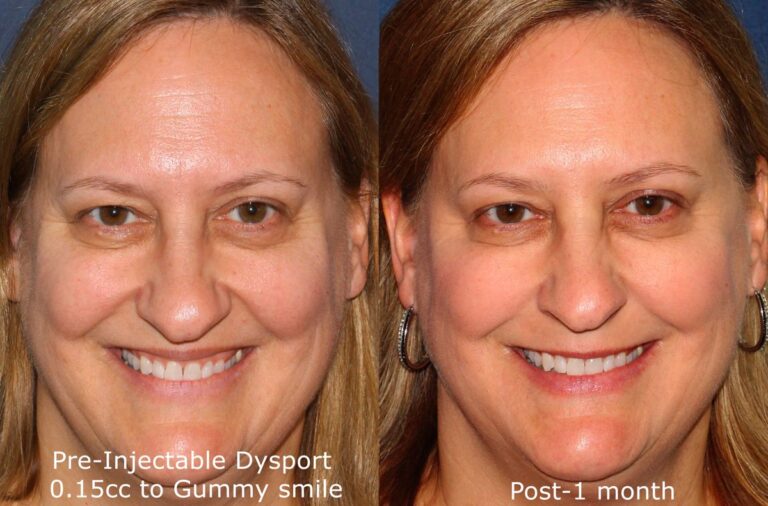 Before and after front image of Dysport treatment on a female's gummy smile performed by Dr. Fabi at our San Diego medical spa