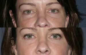 Before and after front image of Restylane treatment on a female's hollowing under the eyes performed by Dr. Fabi at our San Diego medical spa