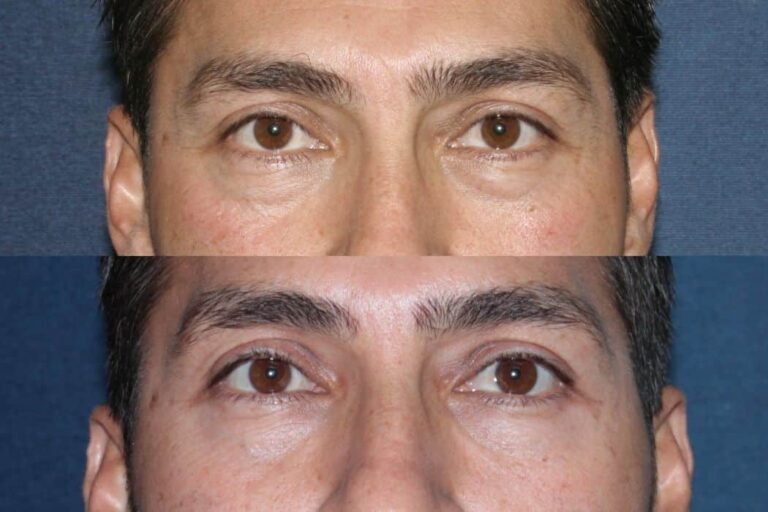 Before and after front image of Restylane treatment on a male's hollowing under the eyes performed by Dr. Fabi at our San Diego medical spa