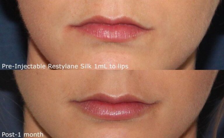 Before and after front image of Restylane Silk treatment on a female's lips performed by Dr. Fabi at our San Diego medical clinic