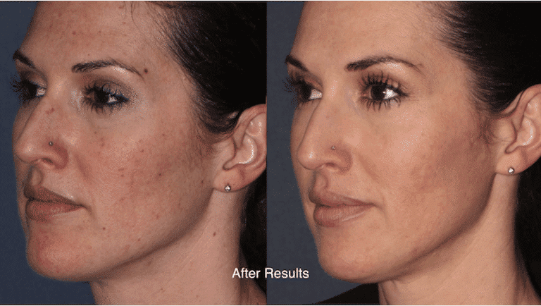 Before and after oblique image of ResurFX treatment on a female's face performed by Dr. Fabi at our San Diego medical spa