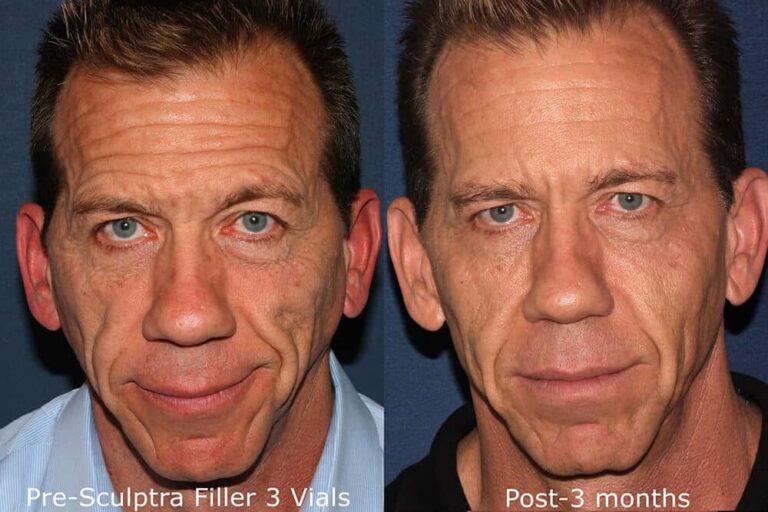 Before and after front image of Sculptra treatment on a male's midface performed by Dr. Fabi at our San Diego medi spa