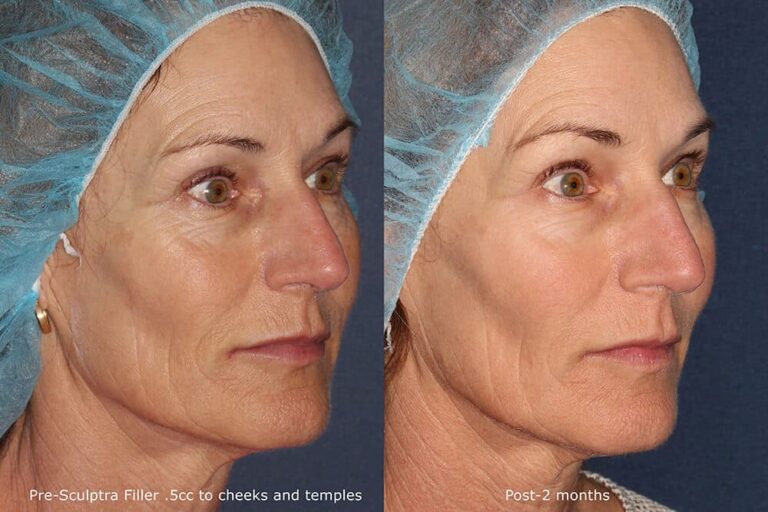Before and after oblique image of Sculptra treatment on a female's midface and temples performed by Dr. Fabi at our San Diego medi spa