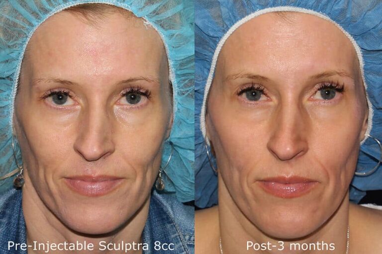 Before and after front image of Sculptra treatment on a female's midface performed by Dr. Fabi at our San Diego medi spa