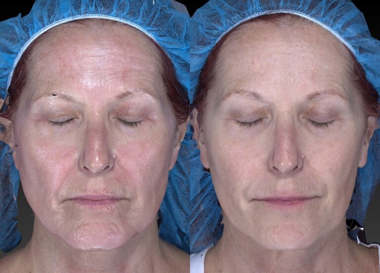 Before and after front image of Radiesse, Belotero and Sculptra treatment on a female's face performed by Dr. Fabi at our San Diego medical spa