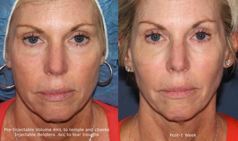 Before and after front image of liquid facelift treatment on a female's face performed by Dr. Fabi at our San Diego medical spa