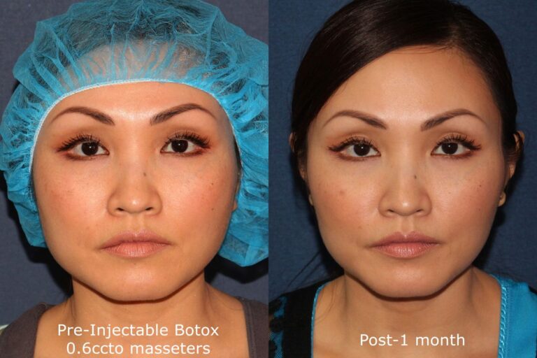 Before and after front image of Botox treatment on a female's masseter muscles performed by Dr. Fabi at our San Diego medical clinic
