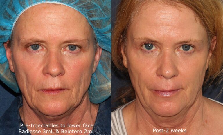 Before and after front image of Radiesse and Belotero treatment on a female's face performed by Dr. Wu at our San Diego medical spa
