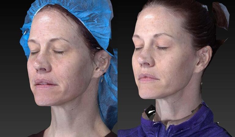 Before and after oblique image of dermal filler treatment on a female's face performed by Dr. Fabi at our San Diego medical spa