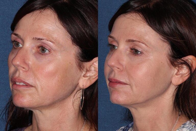 Before and after oblique image of Belotero treatment on a female's face performed by Dr. Groff at our San Diego medical clinic