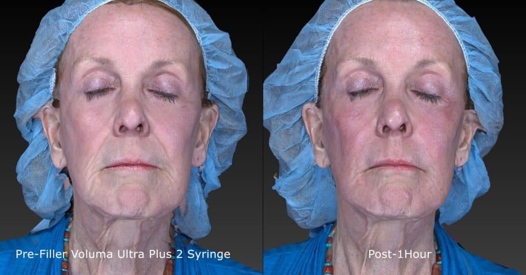 Voluma filler treatment for cheek augmentation. Disclaimer: Results may vary from patient to patient. Results are not guaranteed. Actual un-retouched patient before and after.