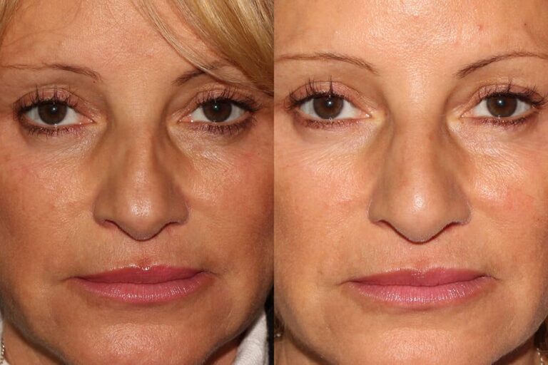 Before and after front image of dermal filler treatment on a female's face performed by Dr. Goldman at our San Diego medi spa