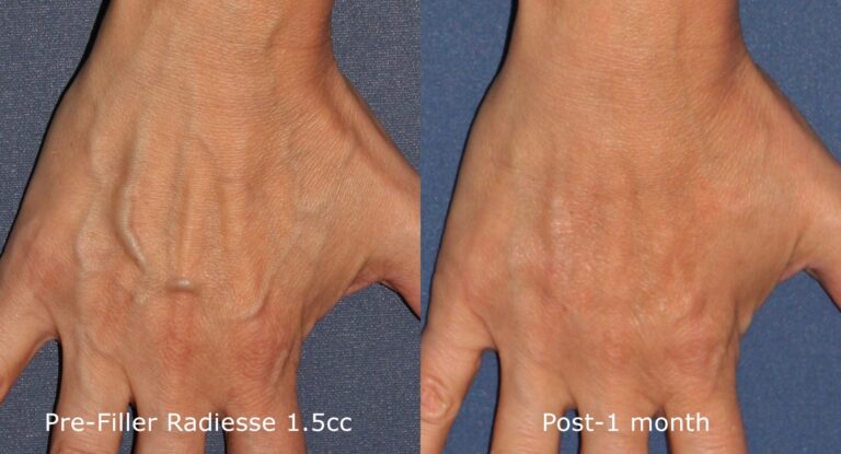 Before and after front image of Radiesse treatment on a female's hands performed by Dr. Goldman at our San Diego medical spa