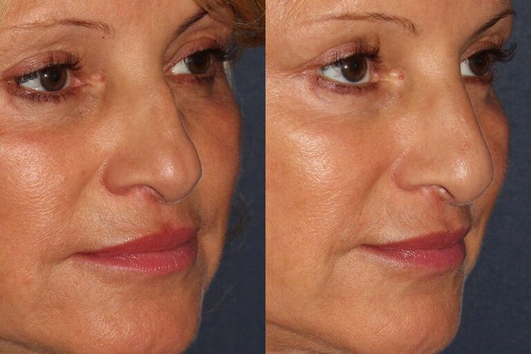 liquid facelift before and after in san diego, ca