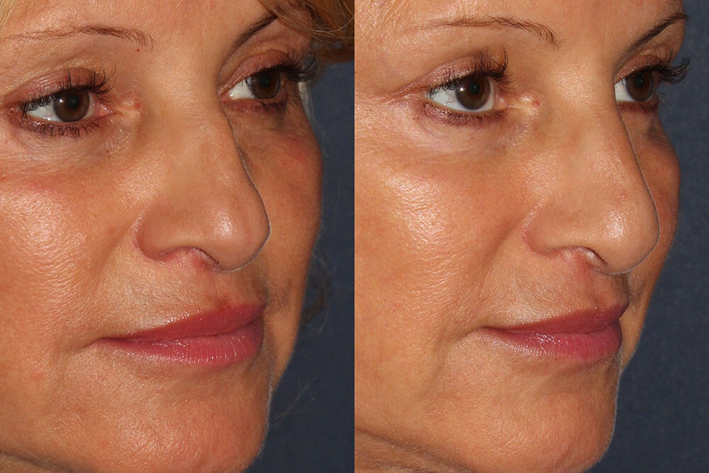 before and after dermal fillers