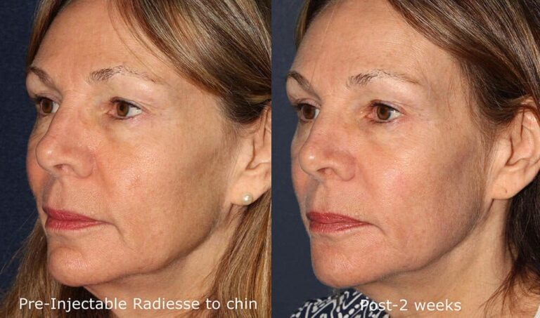 Before and after oblique image of Radiesse treatment on a female's chin performed by Dr. Goldman at our San Diego medi spa