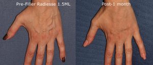 Before and after front image of Radiesse treatment on a female's hands performed by Dr. Goldman at our San Diego medical spa