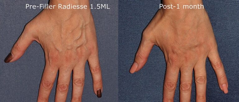 Before and after front image of Radiesse treatment on a female's hands performed by Dr. Goldman at our San Diego medical spa