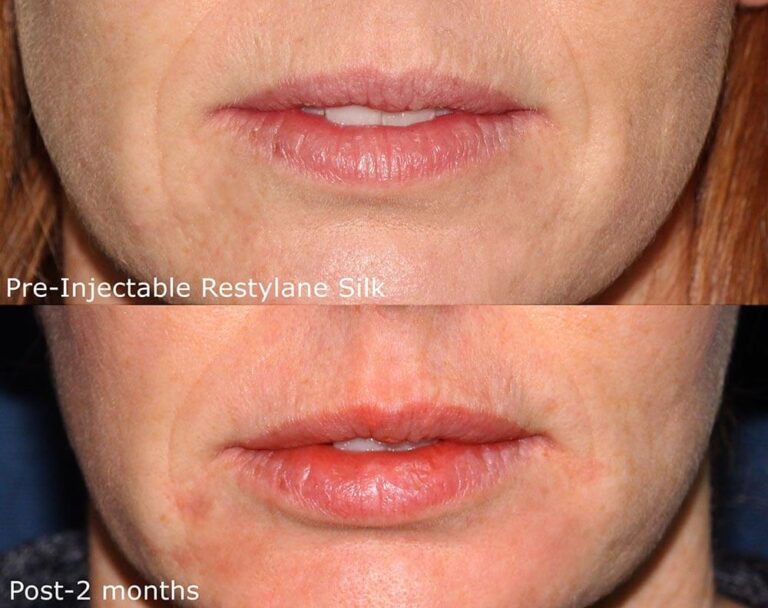 Before and after front image of Restylane Silk treatment on a female's lips performed by Dr. Goldman at our San Diego medical clinic