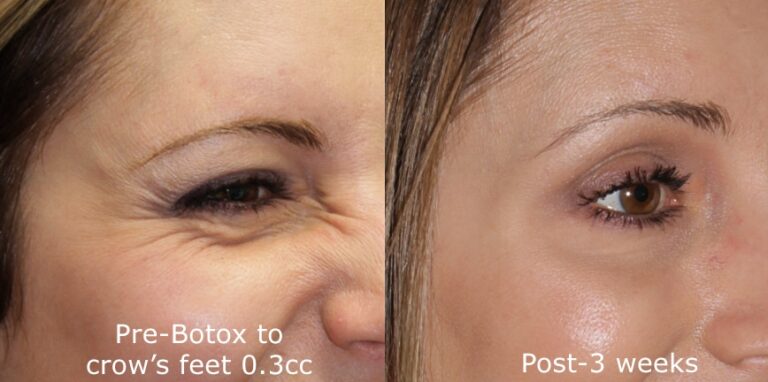 Before and after oblique image of Botox treatment on a female's crow's feet performed by Dr. Groff at our San Diego medical clinic