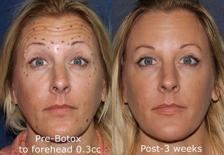 Before and after front image of Botox treatment on a female's forehead lines performed by Dr. Groff at our San Diego medical spa