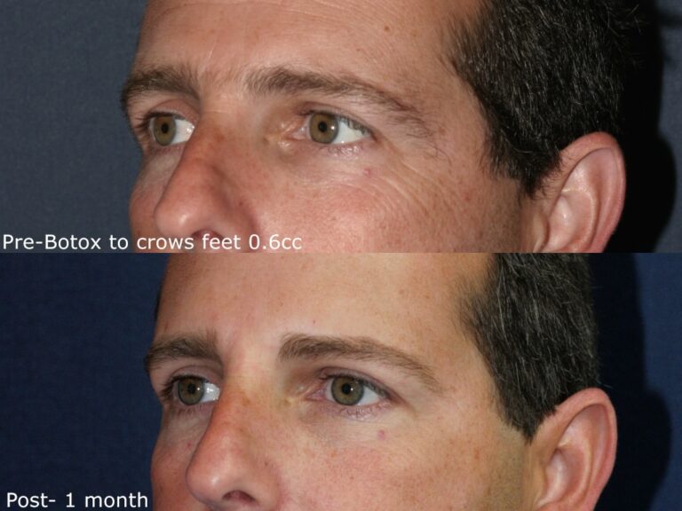 Before and after oblique image of Botox treatment on a male's crow's feet performed by Dr. Groff at our San Diego medical spa