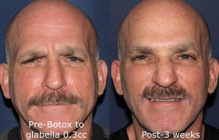 Before and after front image of Botox treatment on a male's forehead and glabellar lines performed by Dr. Groff at our San Diego medical spa