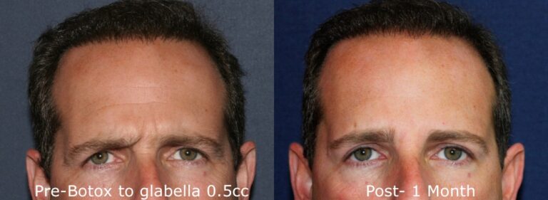 Before and after front image of Botox treatment on a male's forehead and frown lines performed by Dr. Groff at our San Diego medical spa