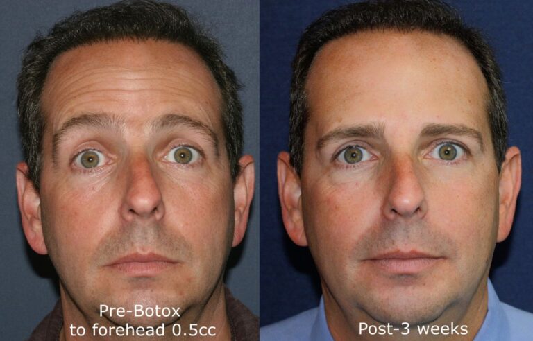 Before and after front image of Botox treatment on a male's forehead lines performed by Dr. Groff at our San Diego medical spa