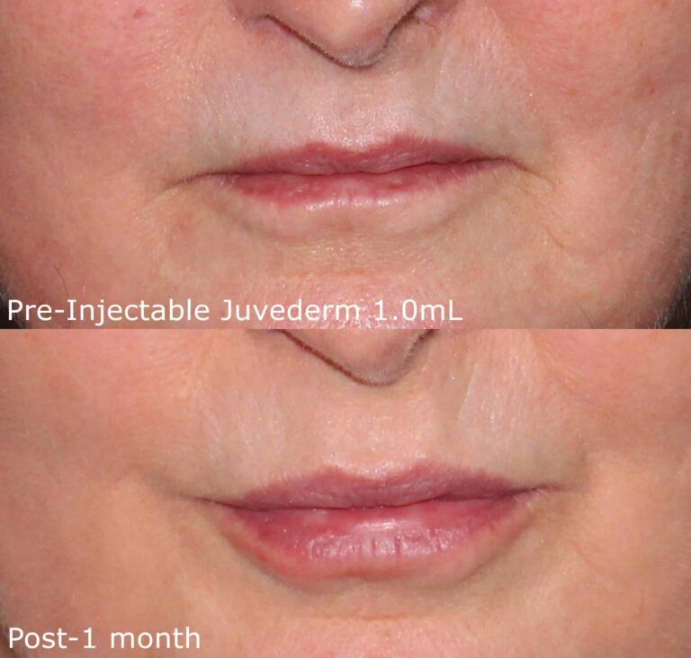 Before and after front image of Juvederm treatment on a female's lips performed by Dr. Groff at our San Diego medi spa