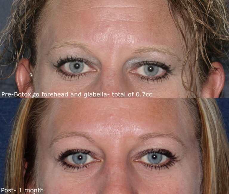 Before and after front image of Botox treatment on a female's forehead and glabellar lines performed by Dr. Groff at our San Diego medical spa