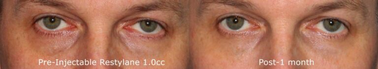 Before and after front image of Restylane treatment on a male's hollowing under the eyes performed by Dr. Groff at our San Diego medical spa