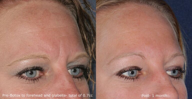 Before and after oblique image of Botox treatment on a female's glabellar lines performed by Dr. Groff at our San Diego medical spa