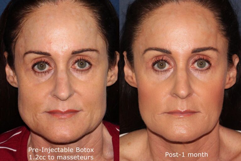 Before and after front image of Botox treatment on a female's masseter muscles performed by Dr. Groff at our San Diego medical spa