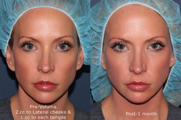 Before and after front image of Voluma treatment on a female's temples and cheeks performed by Dr. Groff at our San Diego med spa