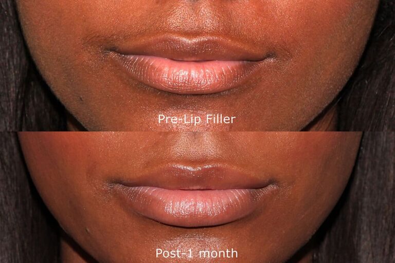Before and after front image of Juvederm treatment on a female's lips performed by Dr. Groff at our San Diego medi spa