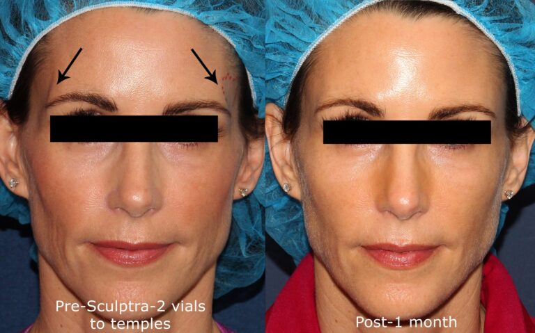 Before and after front image of Sculptra treatment on a female's temples performed by Dr. Groff at our San Diego medi spa