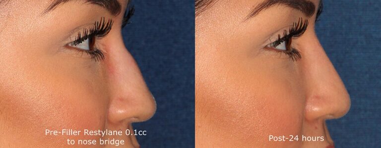 Before and after side image of Restylane treatment on a female's nose bump performed by Dr. Groff at our San Diego medical clinic