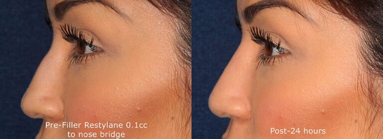 Before and after side image of Restylane treatment on a female's nose bump performed by Dr. Groff at our San Diego medical clinic