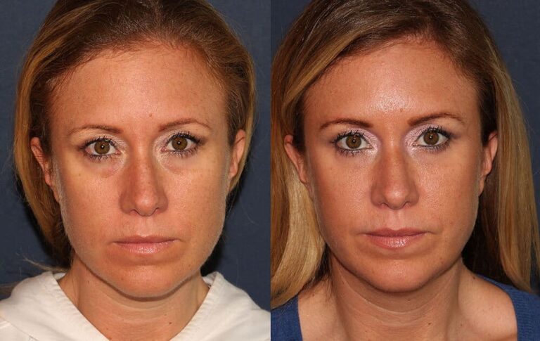 Before and after front image of Restylane treatment on a female's hollowing under the eyes performed by Dr. Groff at our San Diego medical spa
