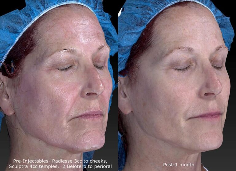 Before and after oblique image of Radiesse treatment on a female's cheeks performed by Dr. Fabi at our San Diego medical spa