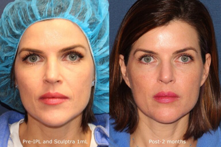 Before and after front image of Sculptra treatment on a female's nasolabial folds performed by Dr. Fabi at our San Diego medi spa