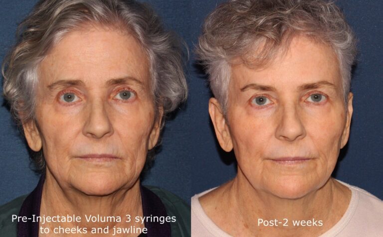 Before and after front image of Voluma treatment on a female's cheeks and jawline performed by Dr. Fabi at our San Diego medical spa