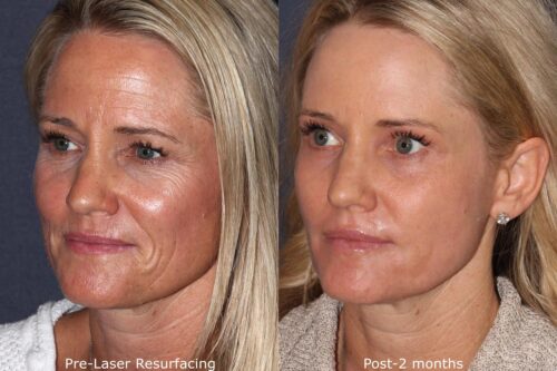 Before and after oblique image of laser resurfacing treatment on a female's face performed by Dr. Groff at our San Diego medical spa